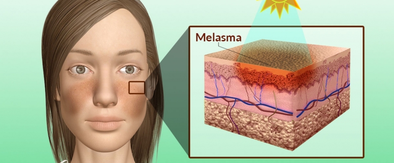 melasma skin lightening topical
