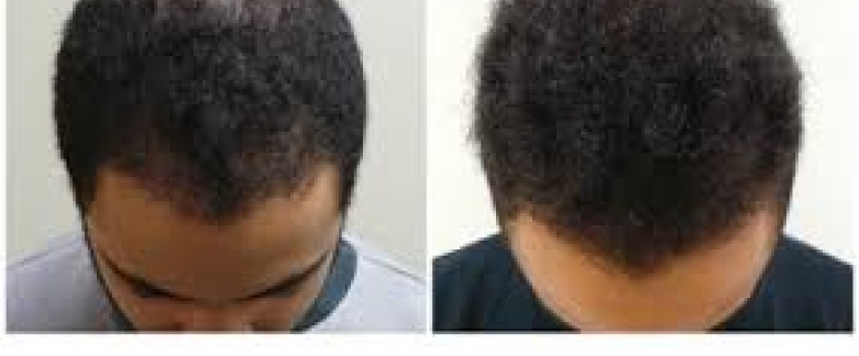 hair loss treatment -prp
