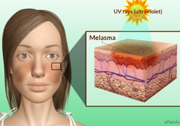 melasma skin lightening topical