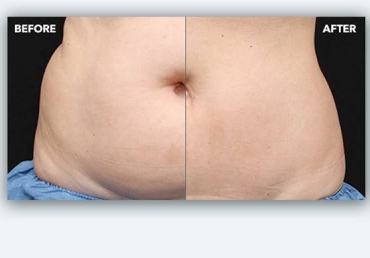 fat reduction non surgical