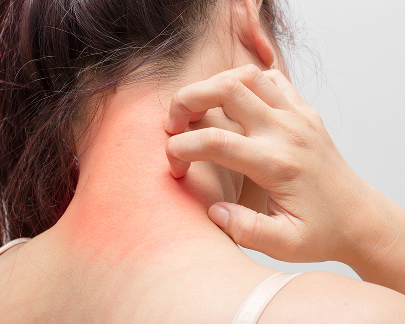 Itching / Rashes / Dermatitis
