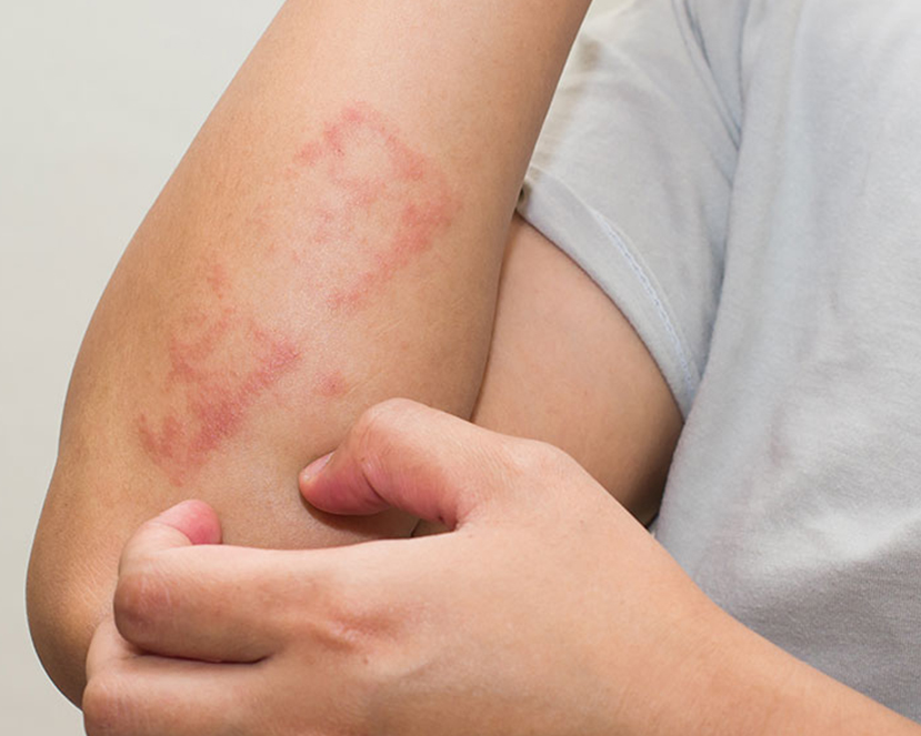 Psoriasis