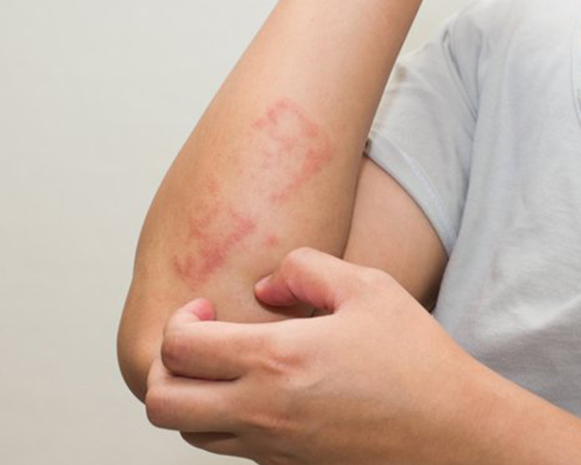 Skin Infections
