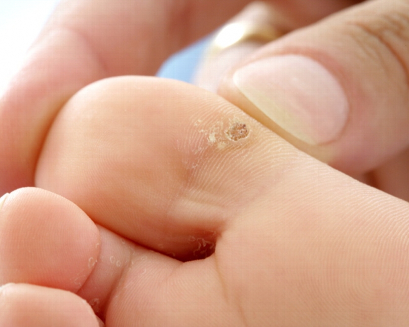 Warts Removal