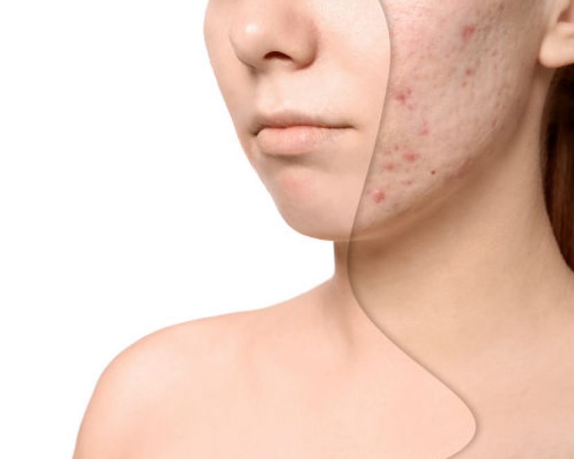 Scar Revision