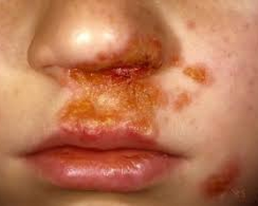 Impetigo